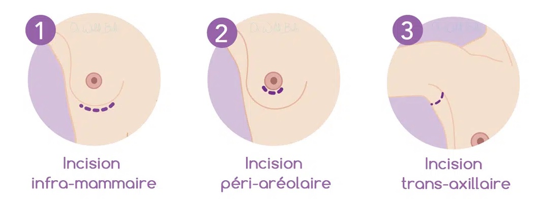 incision implant mammaire
