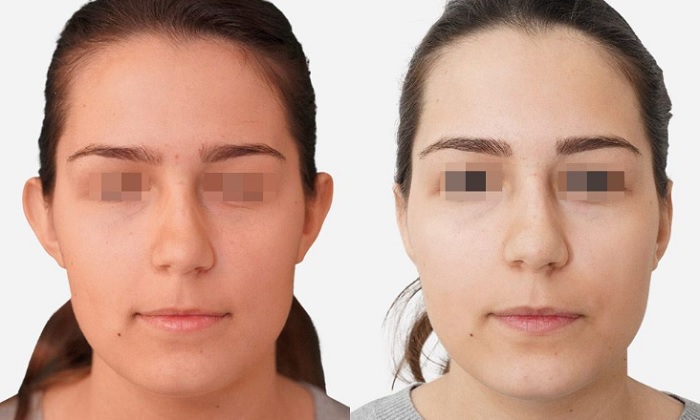 chirurgie esthétique visage photo avant après