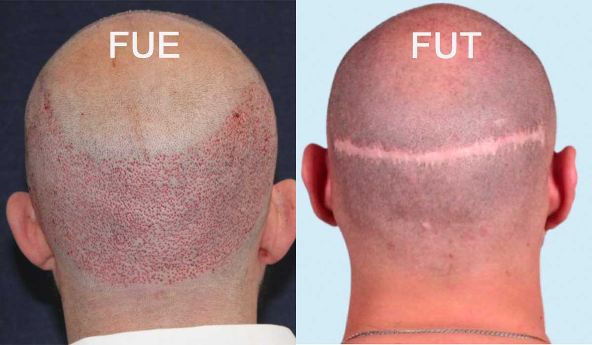 Fue follicular Unit transplant 