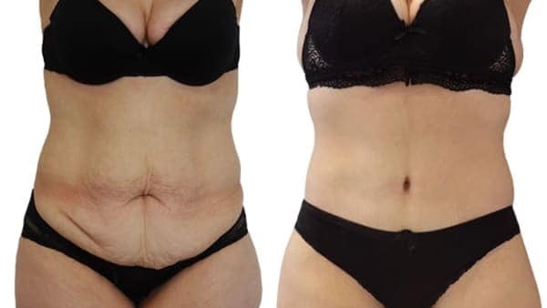 abdominoplastie circulaire