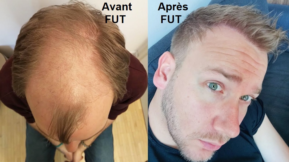 Avant après FUT