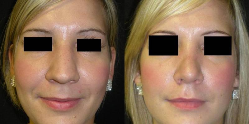 Photos avant et après rhinoplastie gros nez en Turquie