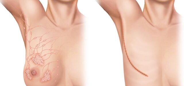La mastectomie en Turquie : guide complet et tarifs