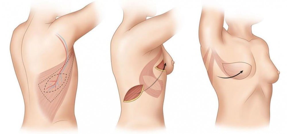 mastectomie et reconstruction immédiate