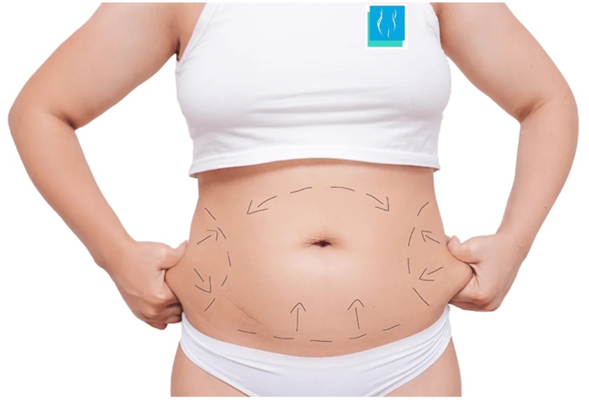 Mini abdominoplastie Turquie