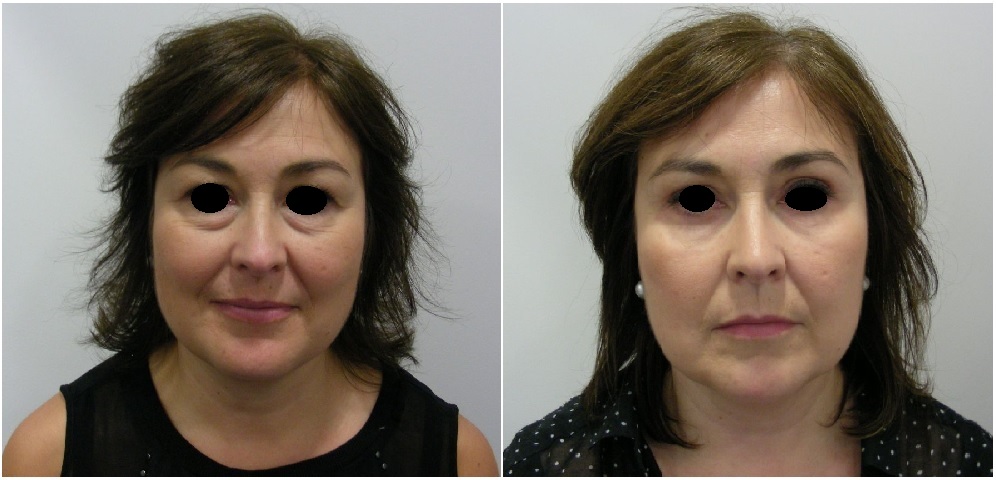 Photos avant et après blépharoplastie combinée