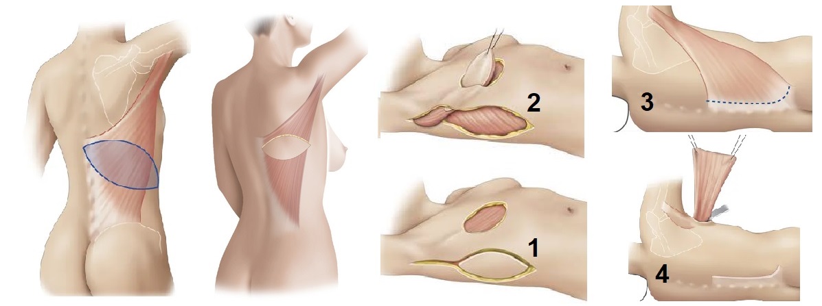 reconstruction mammaire par lambeau musculo-cutané du grand dorsal