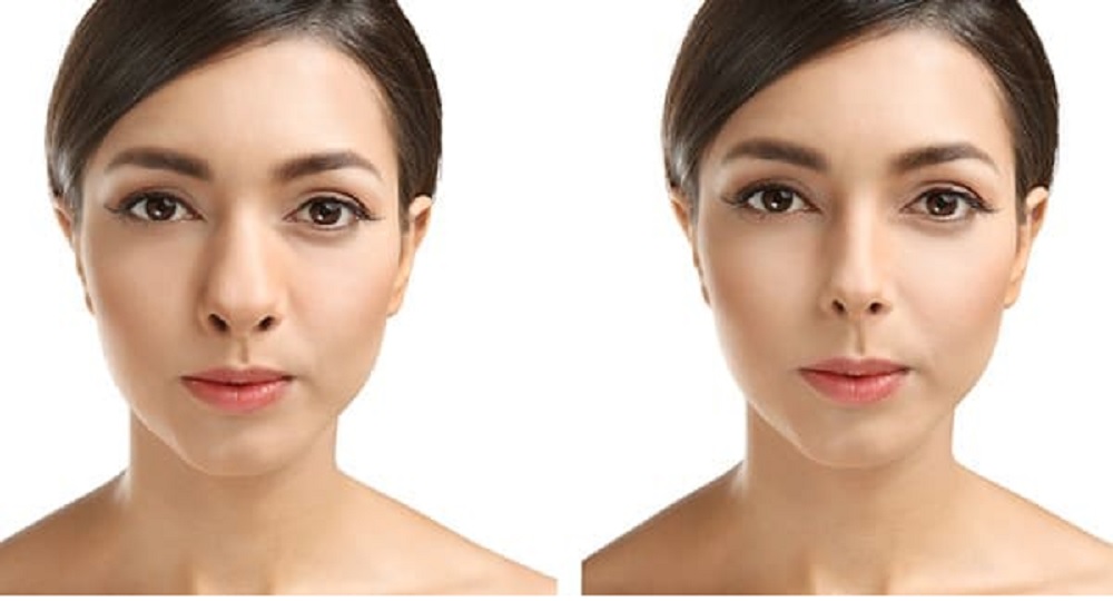 rhinoplastie gros nez Turquie